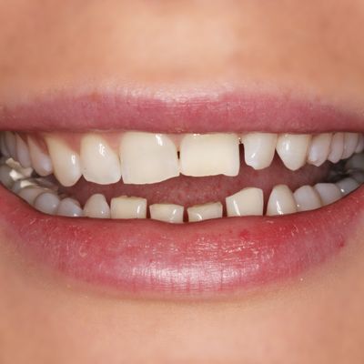 Composite Bonding - Smile 18 before